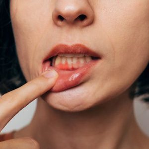 Lady shows inflamed gum tissue