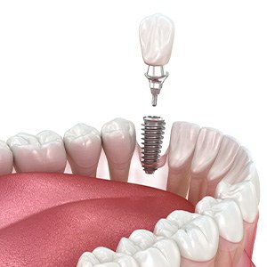 Illustration of a single dental implant