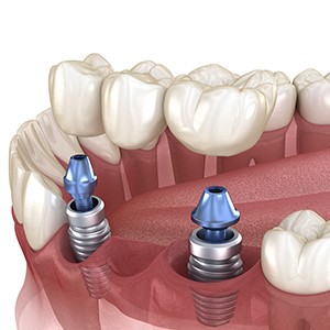 Illustration of an implant bridge