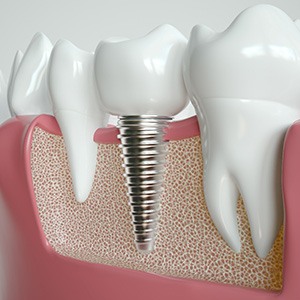 Illustration of implant fusing with jawbone in West Jordan 