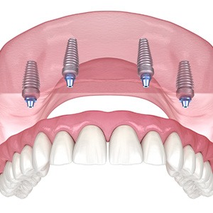 Illustration of an implant denture