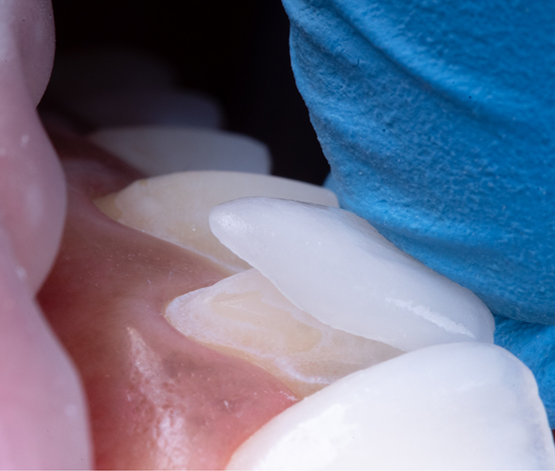 CLose up of a cosmetic dentist in West Jordan placing a veneer over a tooth