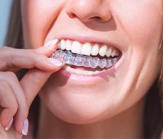 Close up of a person placing a SureSmile clear aligner over their teeth