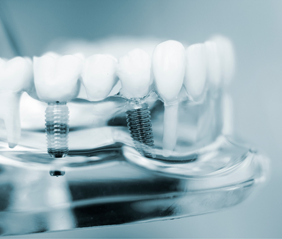 Model of the mouth with two dental implants in West Jordan replacing missing teeth