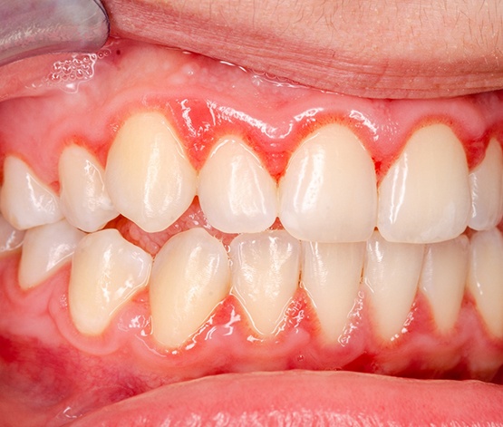 Up-close view of red and inflamed gum tissue