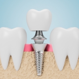 Dental crown being placed over a dental implant