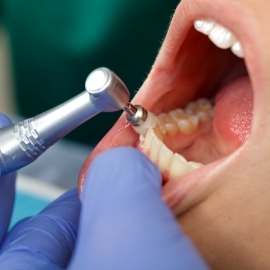 Close up of a dental patient receiving a professional teeth cleaning