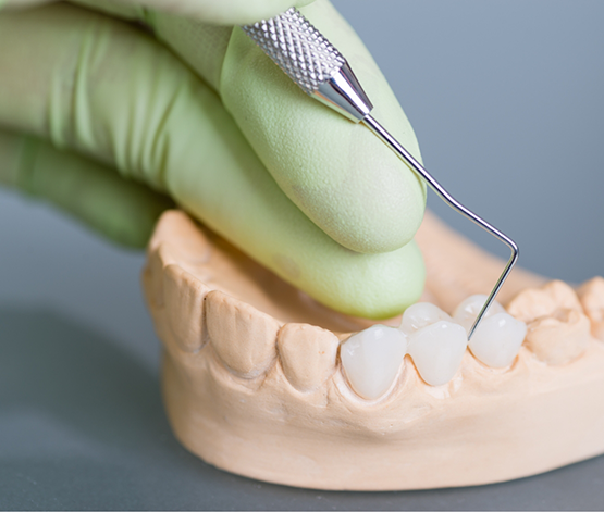 Dentist adjusting a dental bridge in a model of a row of teeth