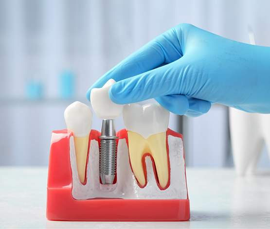 Dentist placing a crown atop a model of a dental implant