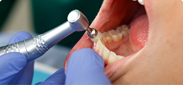Close up of a dental patient receiving a professional teeth cleaning