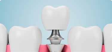 Illustration of a dental crown being placed over a dental implant in the lower jaw