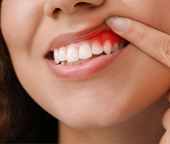 Close up of a person pointing to their red gums