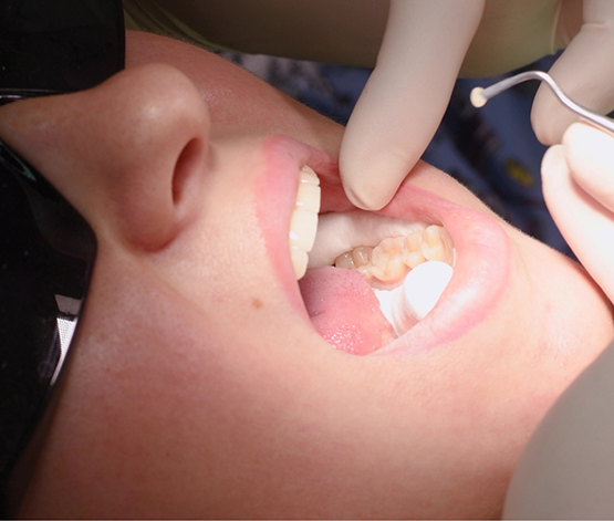 Dentist placing a white filling in a patients tooth