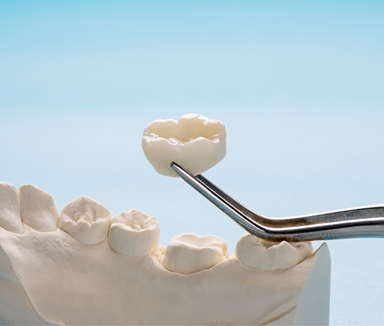 Tweezers holding a dental crown above a model of a row of teeth