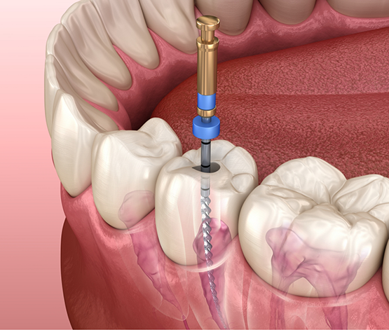 Illustration of a thin dental instrument accessing the center of a tooth during root canal treatment