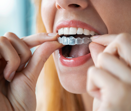 Blonde woman placing a SureSmile clear aligner in West Jordan over her teeth