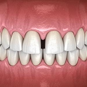 Illustration of gapped teeth
