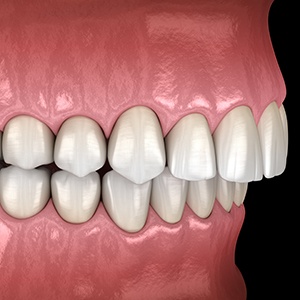 Illustration of an overbite