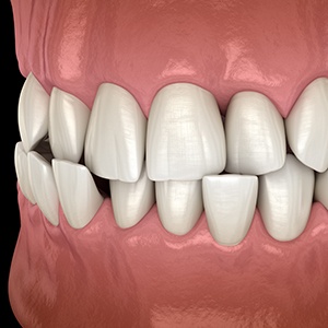 Illustration of a crossbite