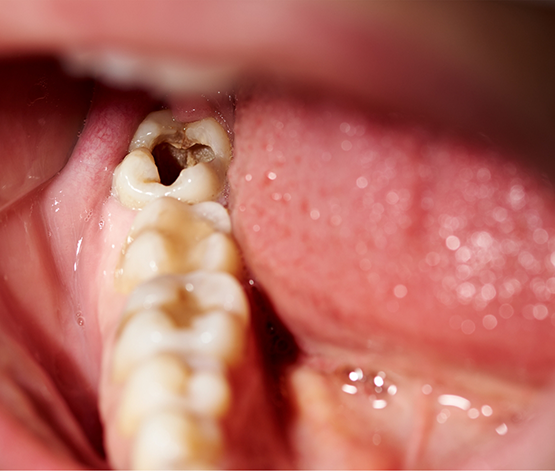 Close up of a damaged tooth that needs a tooth extraction in West Jordan