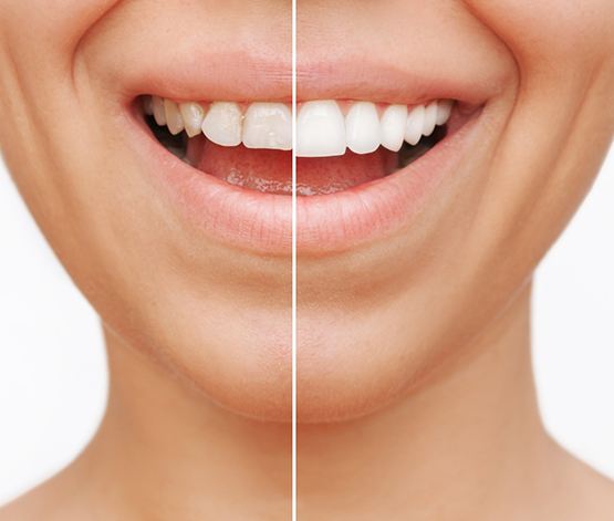 Nose-to-neck view of someone’s smile halved to show before/after cosmetic treatment results