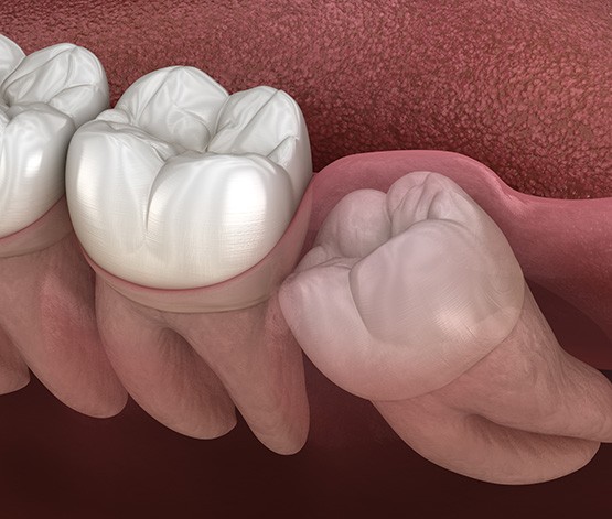 Illustration of wisdom tooth growing in