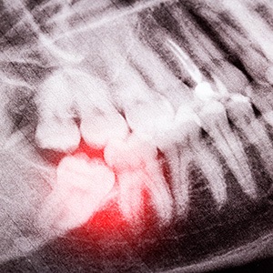 Digital X-ray of wisdom tooth